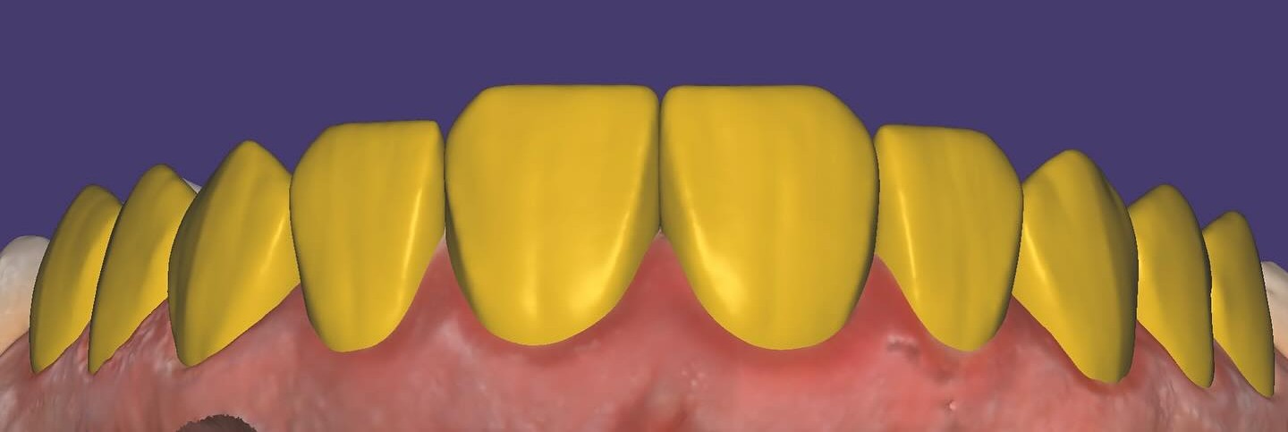 Digital Smile Design